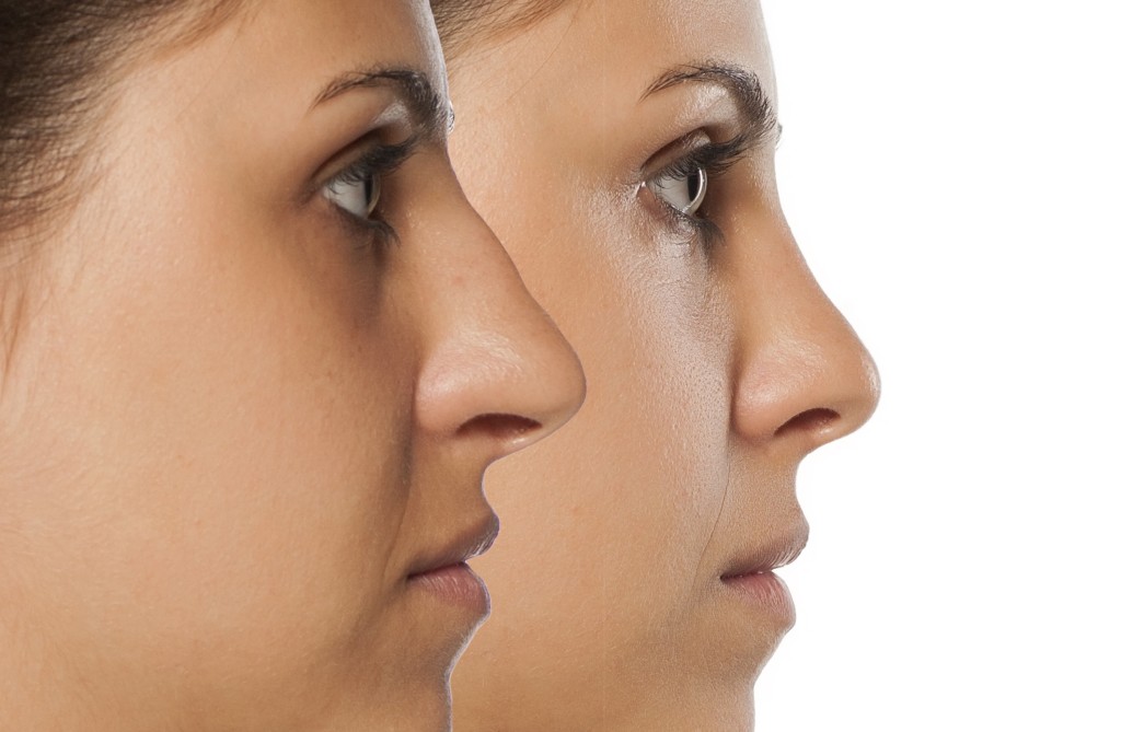 The Top 5 Benefits of a Nose Job
