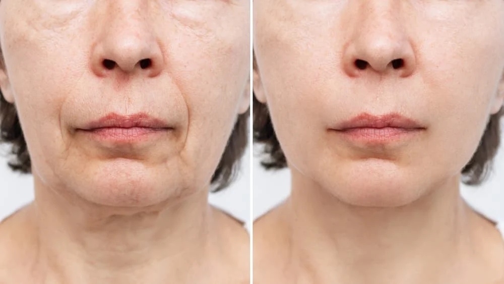 The Complete Guide to Facelift Surgery