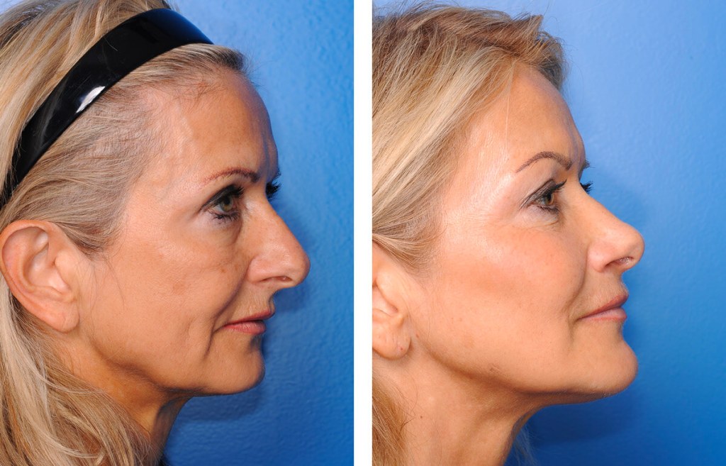 5 Essential Tips for a Successful Facelift Surgery Recovery